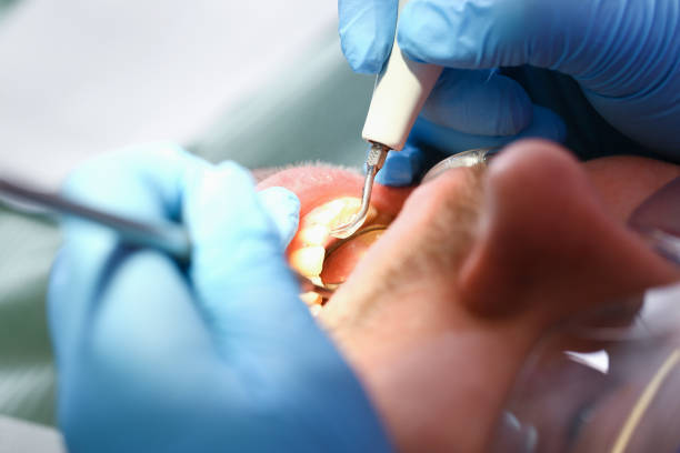Best Emergency Tooth Extraction in Ozona, TX